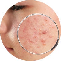 saiba quais são os tipos e graus de acne