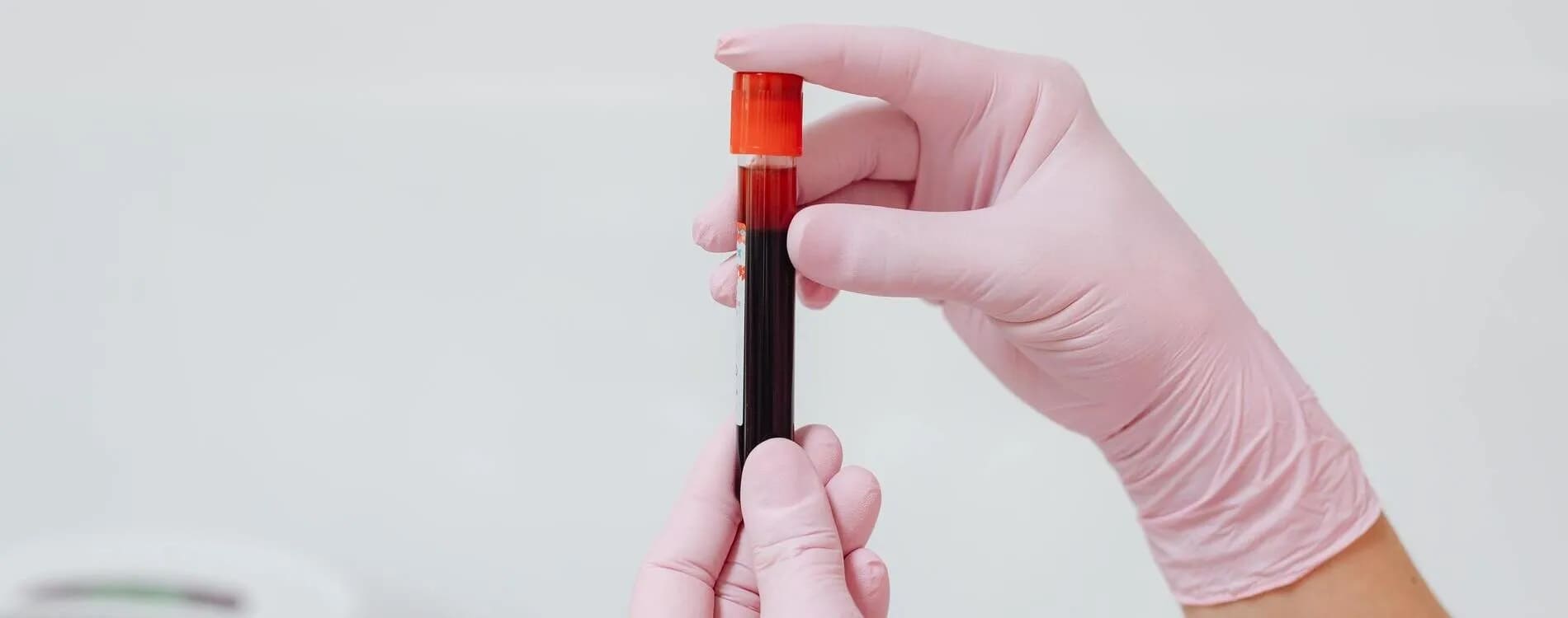o que é anemia hemolítica e sintomas