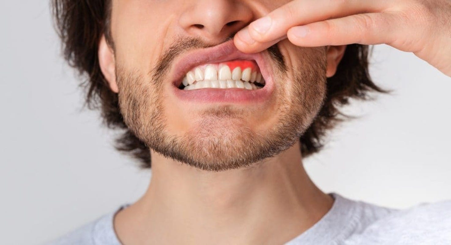 homem com inflamação na gengiva