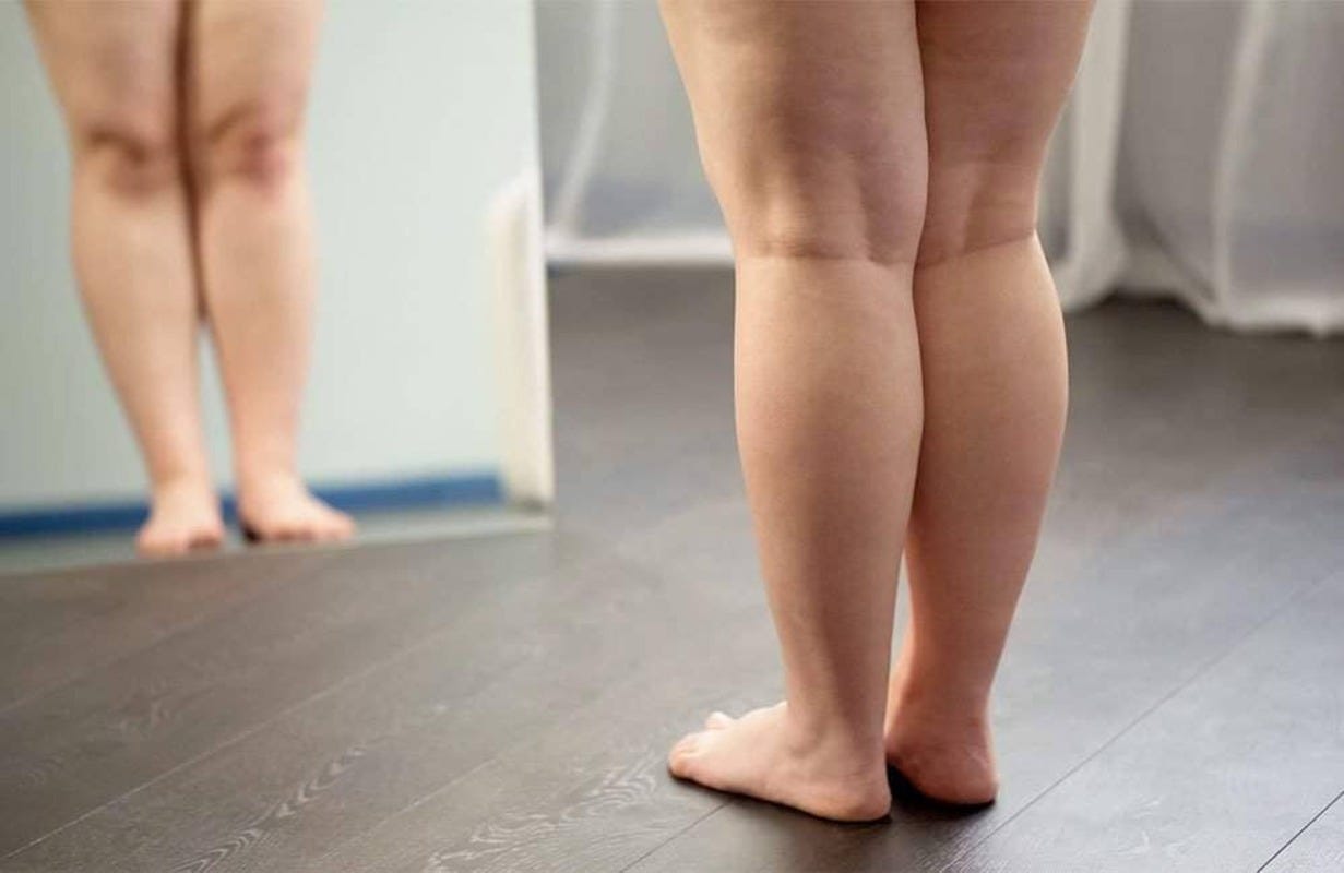 o que é lipedema e sintomas