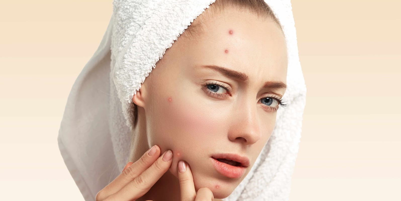 benefícios do Ômega 3 para acne