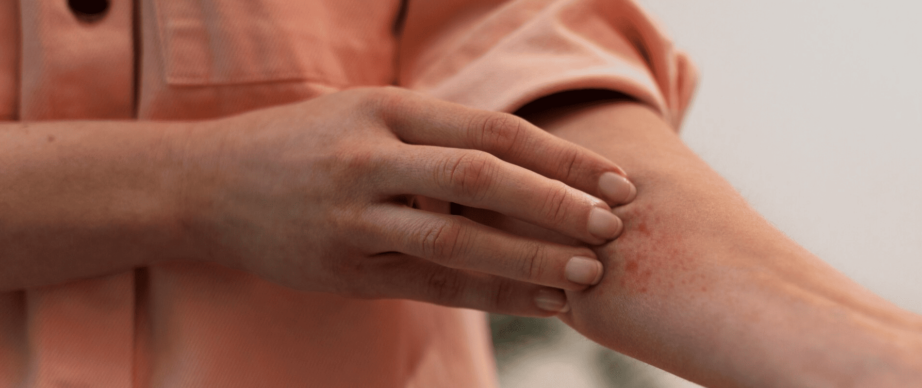 psoriase